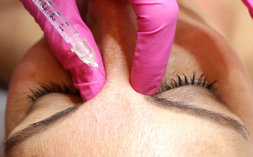 Frown lines Botox, LIPS and SKIN Aesthetic Medicine, Munich