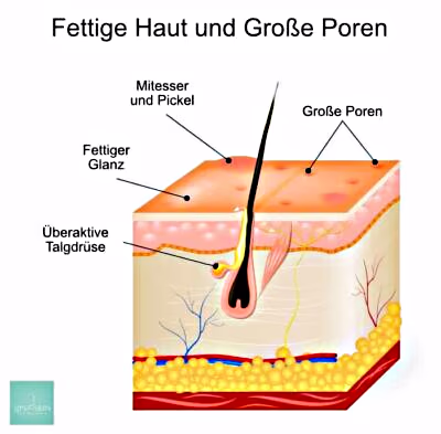 Infografik fettige Haut