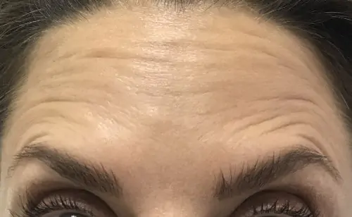 Botox gegen Stirnfalten: Wenn es die Mimik erfordert, dann kann die Stirn nach wie vor in Falten gelegt werden