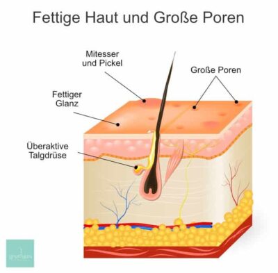 Infographic: Oily Skin and Large Pores