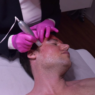 Microneedling Erfahrungen bei Männern