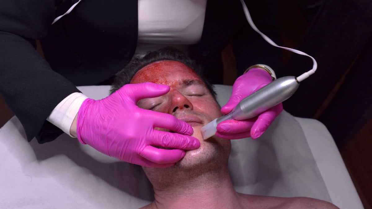 Microneedling for men. I have only made good experiences with this treatment among my male patients.
