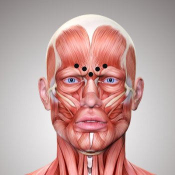 Injektionspunkte für Botox gegen Zornesfalte, die auf einer anatomischen Darstellung eines männlichen Gesichts eingezeichnet sind