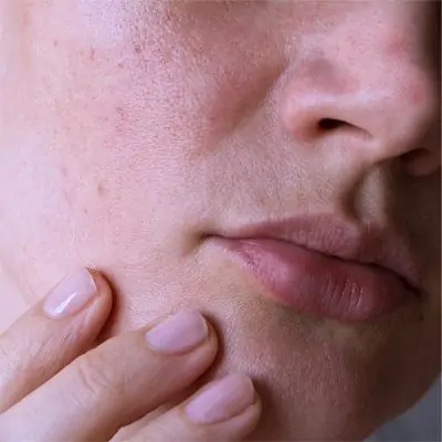 Micro-Botox gegen große Poren und fettige Haut - LIPS and SKIN Ästhetische Medizin München