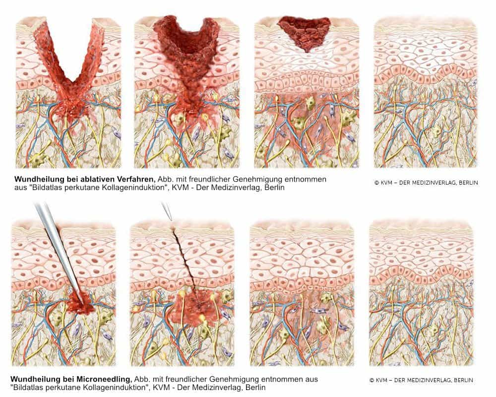 LIPS and SKIN Graphik: Wundheilung bei ablativen Verfahren vs Microneedling