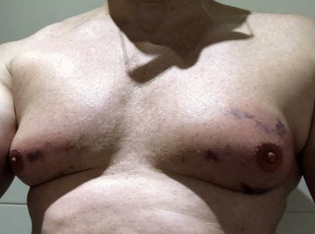 Treatment of male breast (lipomastia) with the fat away injection