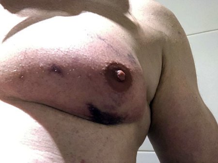 Treatment of male breast (lipomastia) with the fat away injection