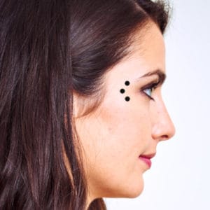 BOTOX Krähenfüße entfernen - LIPS and SKIN Ästhetische Medizin