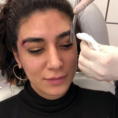 Fadenlifting München - LIPS and SKIN Ästhetische Medizin - Dr. Eva Maria Strobl