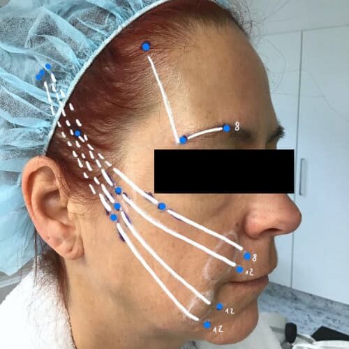 SILHOUETTE SOFT Fadenlifting - Wangen und Augenbrauen