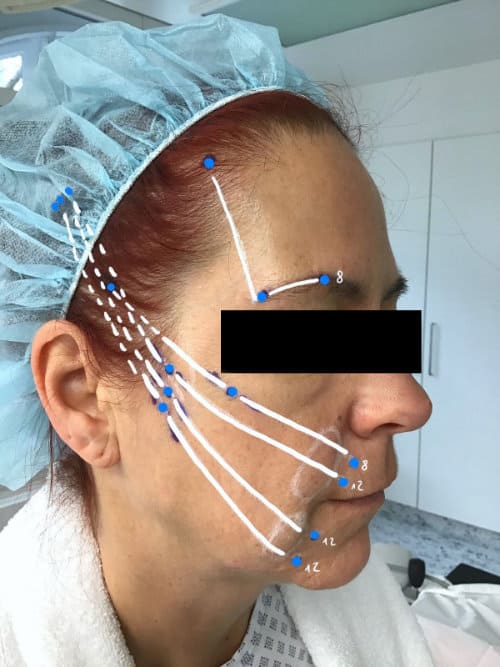 SILHOUETTE SOFT Fadenlifting - Wangen und Augenbrauen