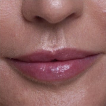 Philtrum - Lips and Skin Ästhetische Medizin
