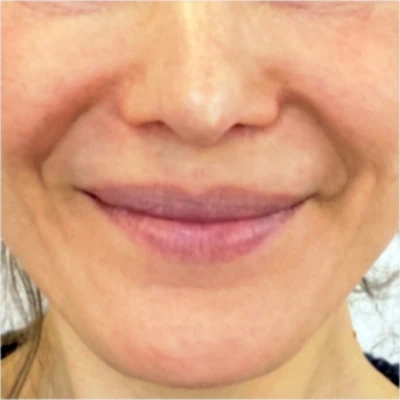 Nasolabialfalte-unterspritzen-LIPS-and-SKIN-Aesthetische-Medizin-400x400px