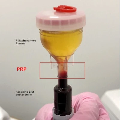 PRP-Behandlung-von-Haarausfall-Was-ist-PRP-