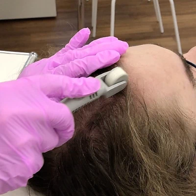 PRP-Microneedling-Haare-LIPS-and-SKIN-Muenchen