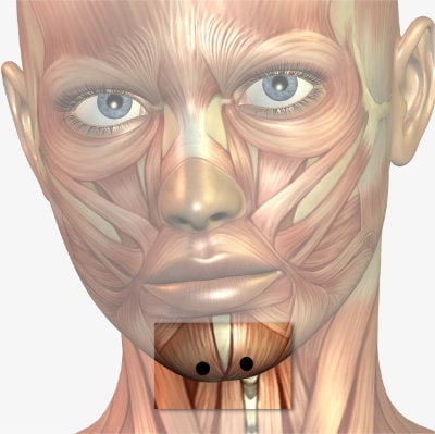 Grafik Erdbeerkinn Botox: Je 3 Einheiten in zwei Injektionspunkte (schwarz) reichen in der Regel aus.