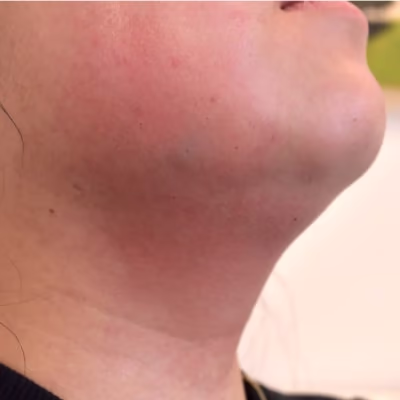 Doppelkinn entfernen München