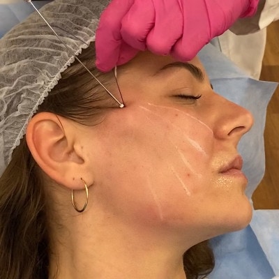 Thread Lift: The Non-Surgical Solution for Facial Sagging