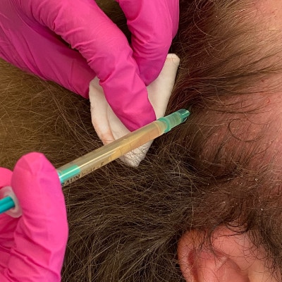 PRP for hair loss performed on a male patient at LIPS and SKIN