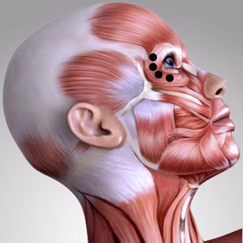 BOTOX-Krähenfüsse-7 Botox gegen Krähenfüße