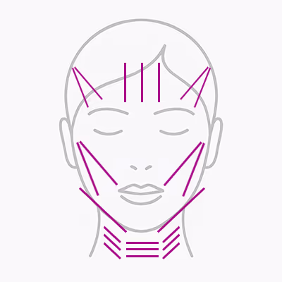 Die Einsatzmöglichkeiten für Fadenlifting im Gesicht und am Hals