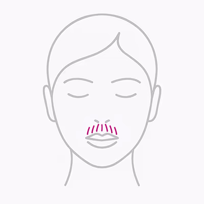 Lippenfältchen unterspritzen mit Hyaluron Lippenfältchen unterspritzen mit Hyaluron
