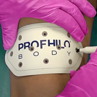 Behandlung mit Profhilo Body bei LIPS and SKIN in München Behandlung mit Profhilo Body bei LIPS and SKIN in München