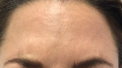 Stirnfalten glätten mit Botox: Bei Entspannung sind Stirnfalten nicht zu sehen.