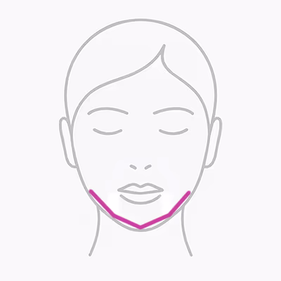 Jawline und Kinn mit Hyaluron konturieren